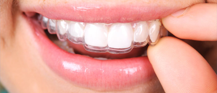 person with clear aligners braces
